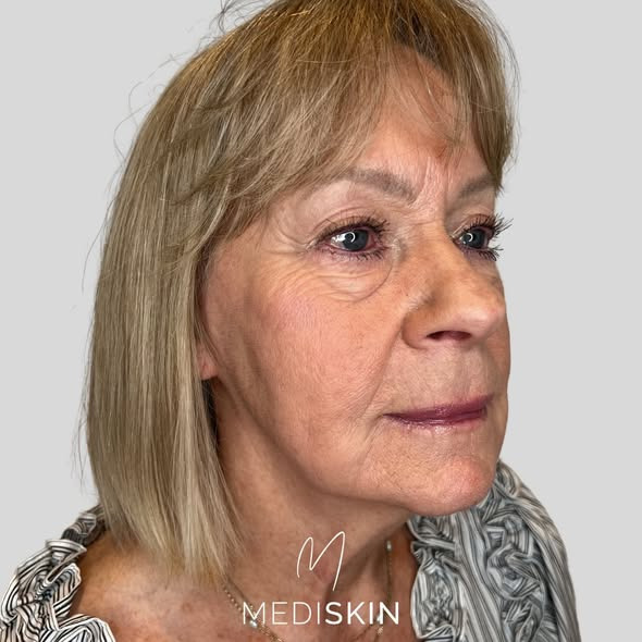 MediSkin viser naturligt resultat efter intern træning på klinikken