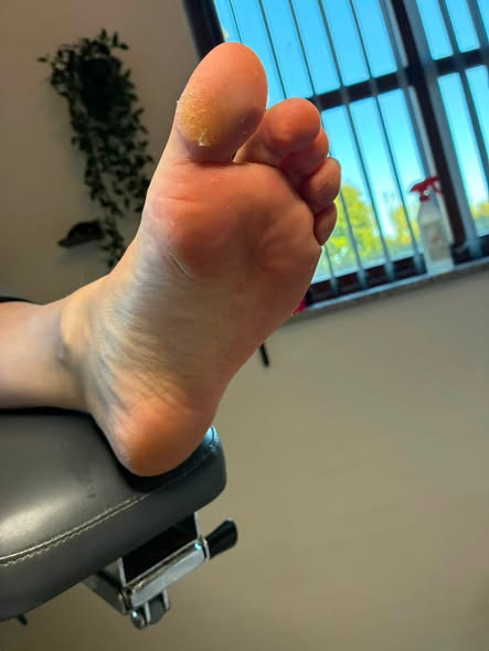 Fodterapeutisk Klinik v/Lajla Andersen får hård hud på storetåen fin igen