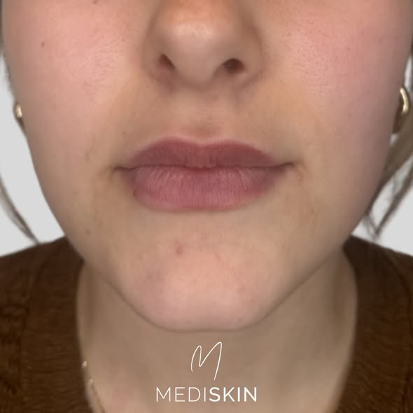 Mediskin fremhæver ekspertise i komplekse læbekorrektioner