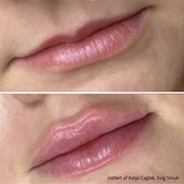 Belotero lips behandling med Russian teknik hos Top Clinic v/Else Møller Larsen i Vejle