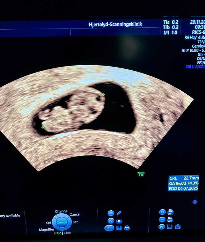 Hjertelyd - scanningsklinik for gravide: Livets mirakel på 22 mm med et færdigdannet hjerte om 3 dage