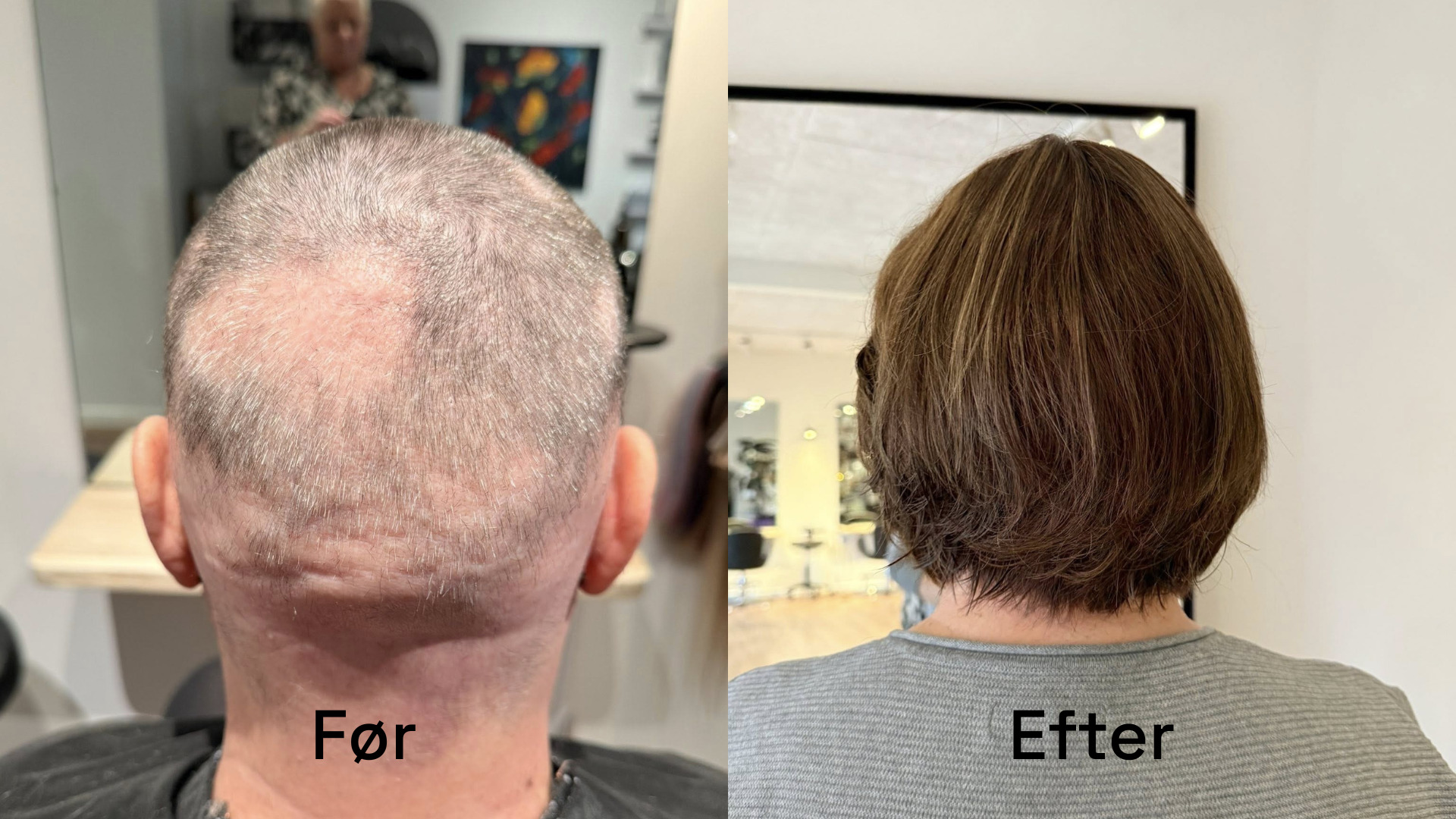 Alopecia – når håret forsvinder, men smilet vender tilbage