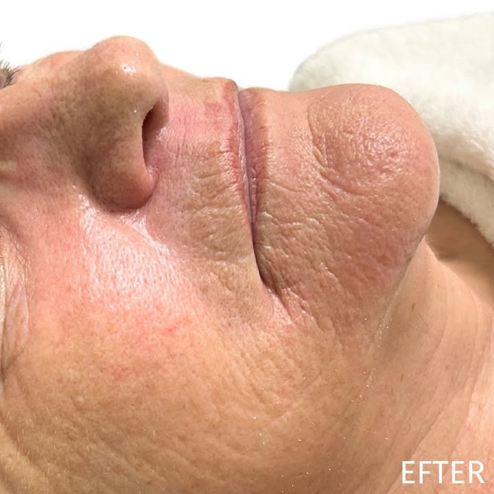 Top Clinic v/Else Møller Larsen inviterer til ungdommelig glød med REVIDERM's Oxygen Boost ansigtsbehandling