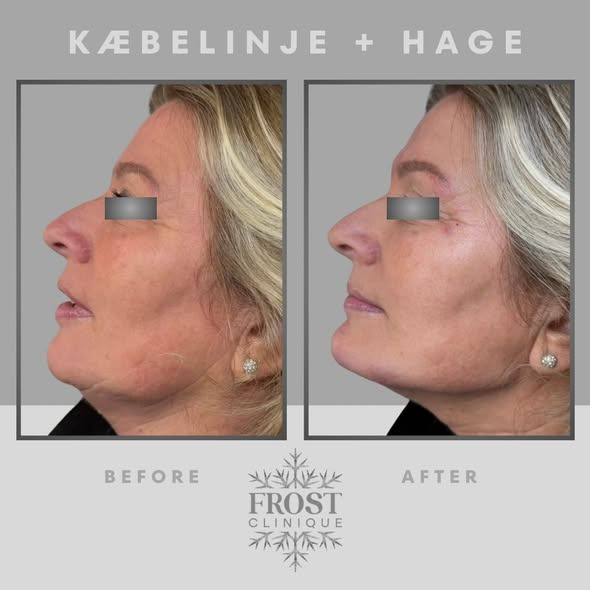 Frost Clinique skaber defineret underansigt med filler-behandling