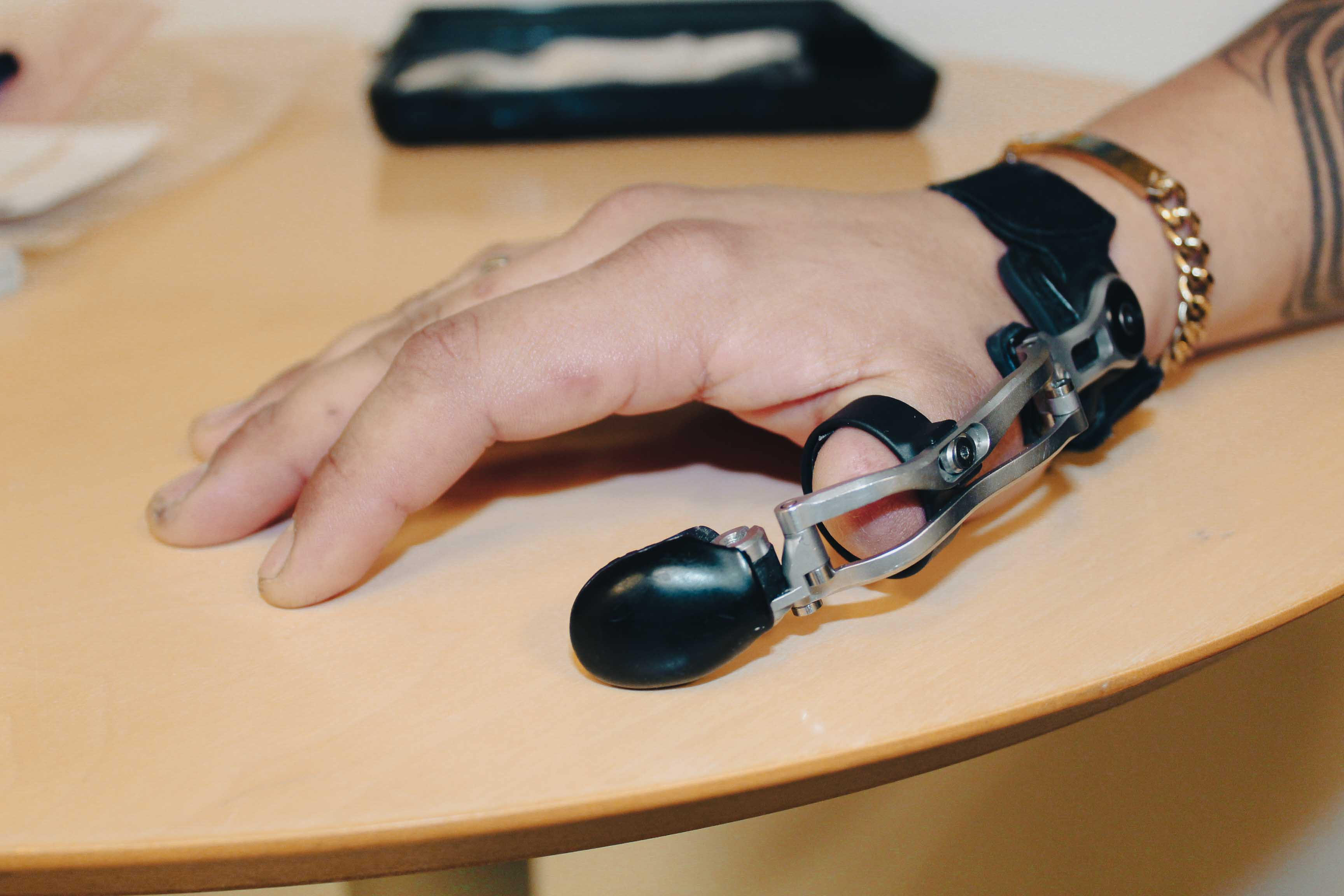 Bandagist i Aalborg vil øge kendskab til innovativ proteseform: Giver fingeramputerede finmotorikken tilbage