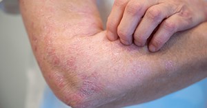 Lone Skov deler indsigt om inflammatoriske hudsygdomme hos Ikast Apotek
