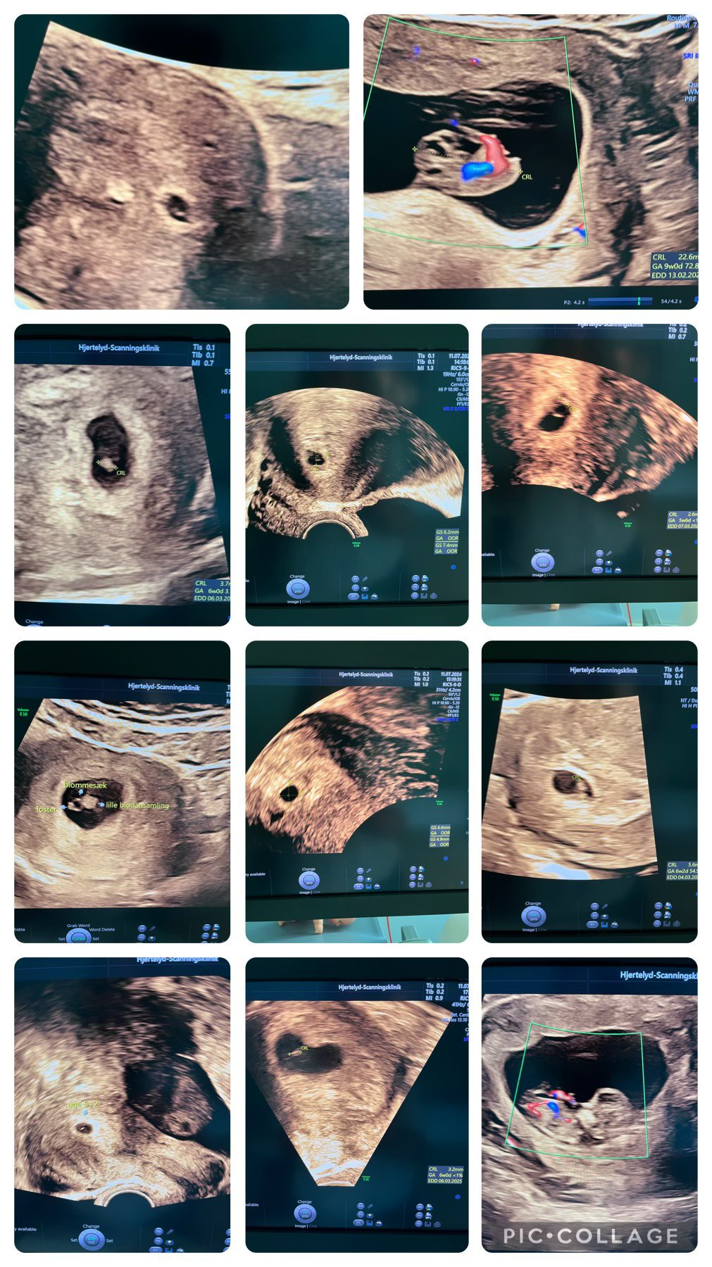 Den tidlige graviditetsscanning er den absolut mest populære scanning. 