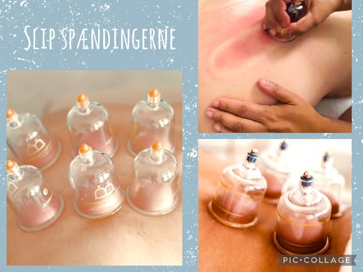 Løwenstein Fysioterapi introducerer cupping for muskelafspænding og øget velvære