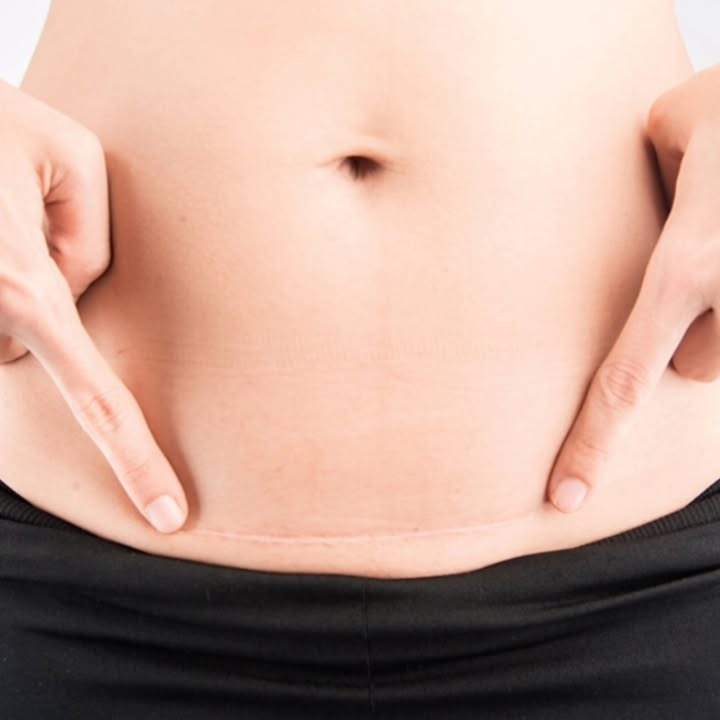 Brandsborgs Kropsterapi tilbyder smertefri laserbehandling til arvæv