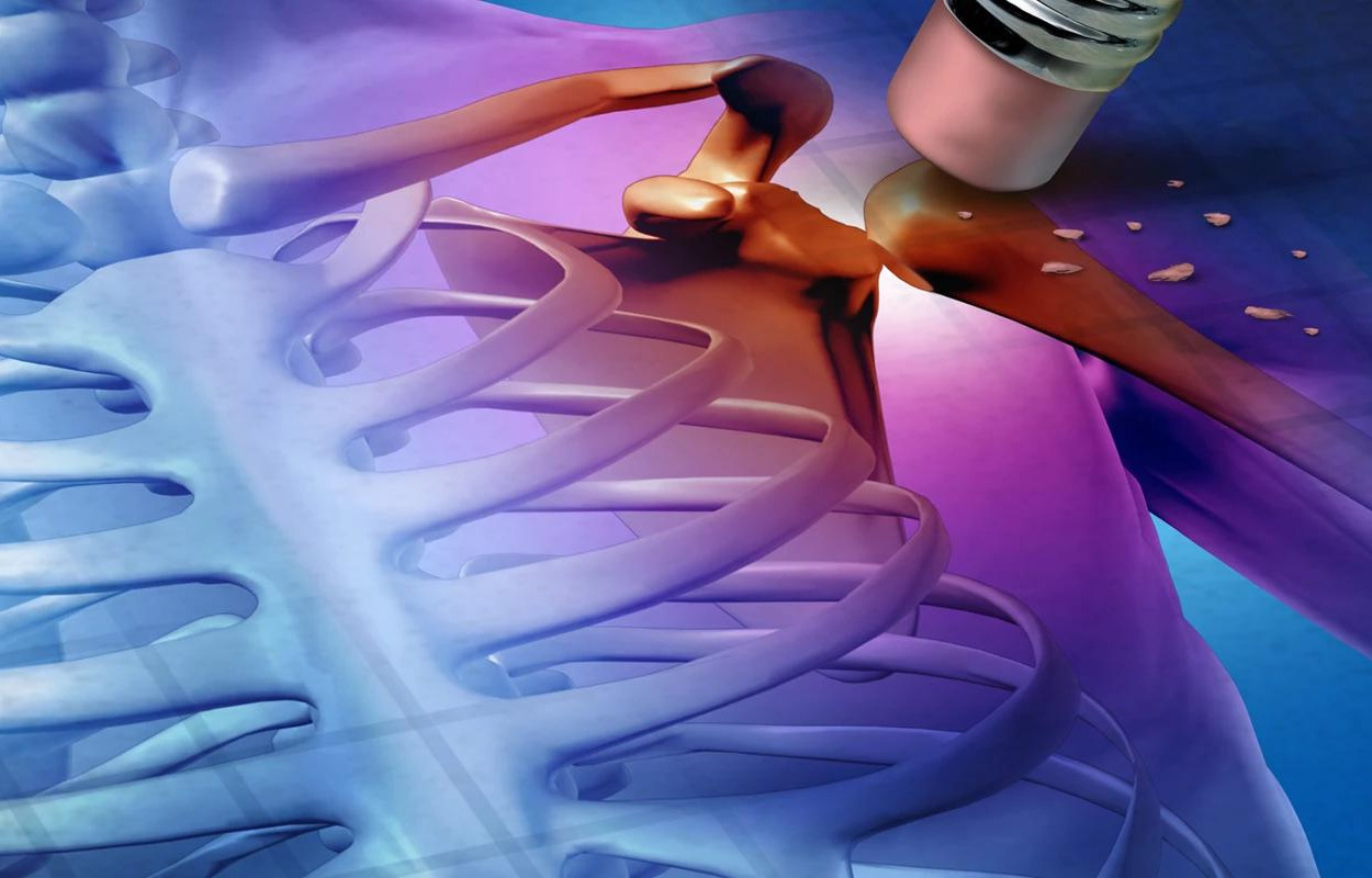 Herning Kommune inviterer til temadag om knogleskørhed i Hammerum 