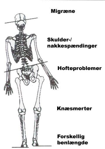 Klinik Dalen forklarer hvordan bækkenets skævhed kan påvirke hele kroppen