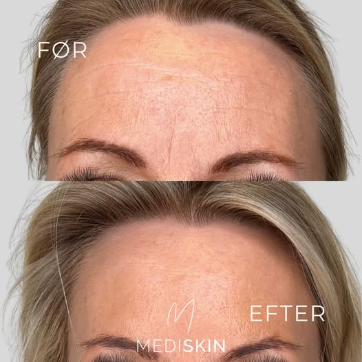 Mediskin anbefaler botox til at forebygge synlige mimiklinjer