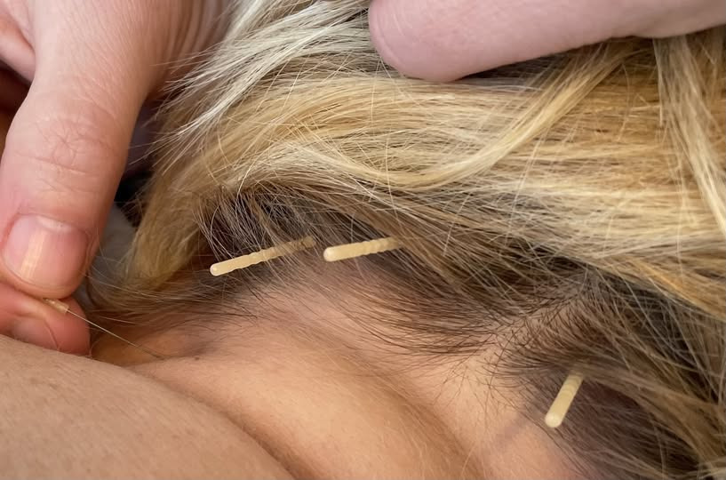 Fyssernes Hus fremhæver akupunktur som naturlig smertelindring for krop og sind