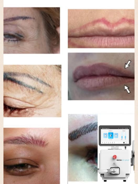 Hair & Skin Zone tilbyder fjernelse af tatoveringer og permanent makeup med laser