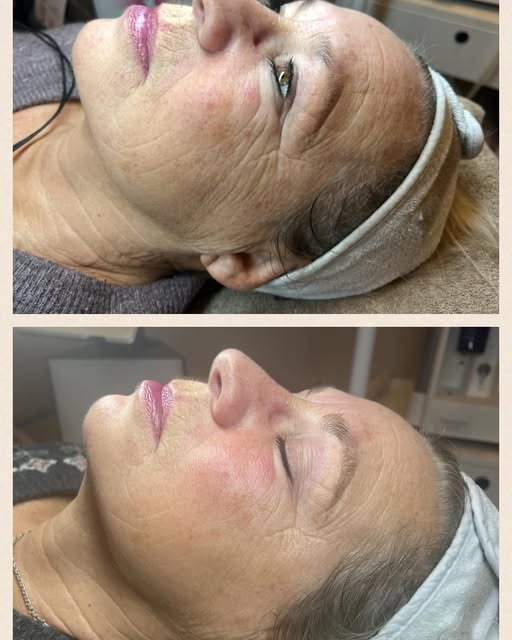 Hair & Skin Zone præsenterer i-Face EMS for naturlig ansigtsopstramning uden nåle