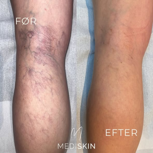 Mediskin opfordrer til at forberede sommerbenene med mikrosklerosering