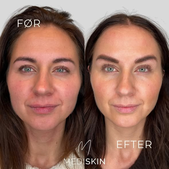 Naturlig opfriskning med Botox hos MediSkin