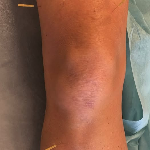 Fyssernes Hus fremhæver akupunkturs fordele i kombination med fysioterapi